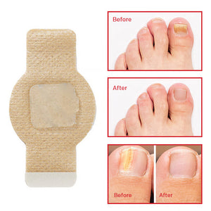 Onychomycosis stickers